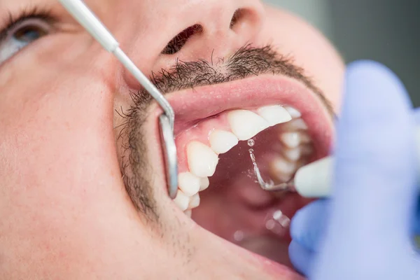 Male patient getting plaque Removing — Stock Photo, Image