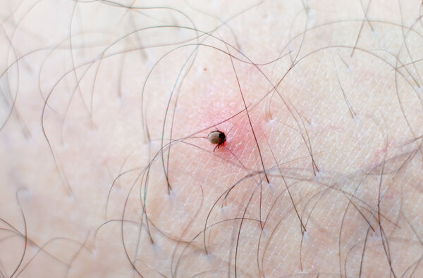 correct removing a tick