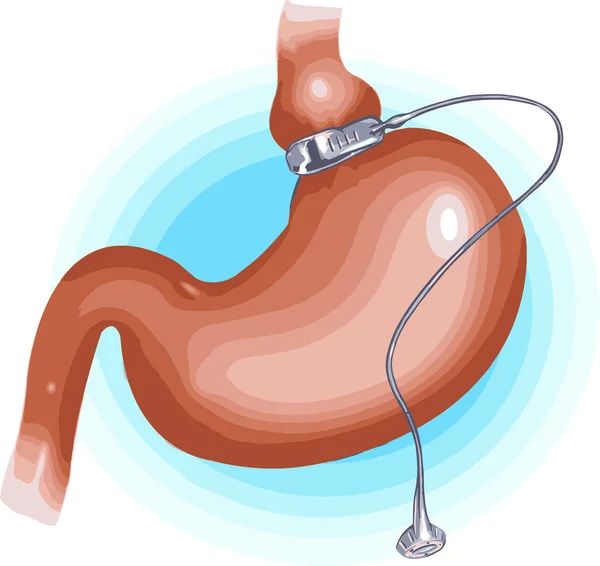 Vektor illustration av en Gastric Band viktminskning kirurgi — Stock vektor