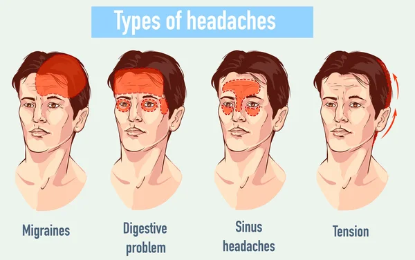 Ilustração sobre dores de cabeça 4 tipo em diferentes áreas do paciente —  Vetores de Stock