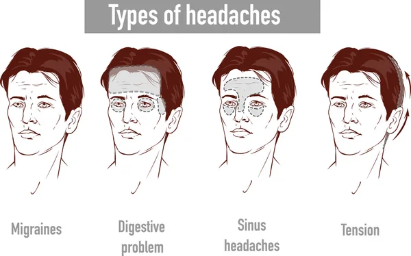 รูปภาพเกี่ยวกับอาการปวดหัว 4 ประเภทในพื้นที่ของผู้ป่วยที่แตกต่างกัน — ภาพเวกเตอร์สต็อก