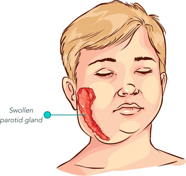 Niños glándula salival hinchazón vector ilustración — Archivo Imágenes Vectoriales