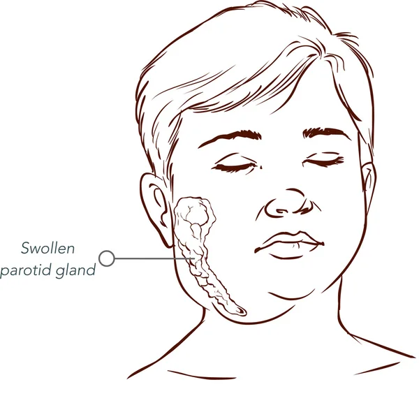 Children salivary gland swelling vector illustration — Stock Vector