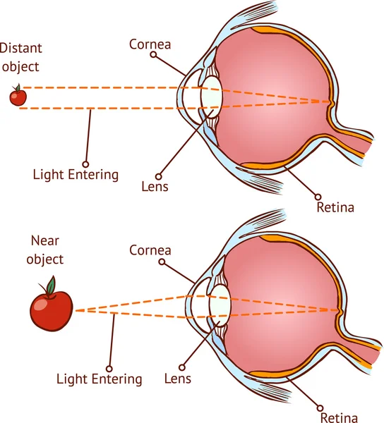 Myopia และวิสัยทัศน์ปกติ (ภาพเวกเตอร์สี  ) — ภาพเวกเตอร์สต็อก