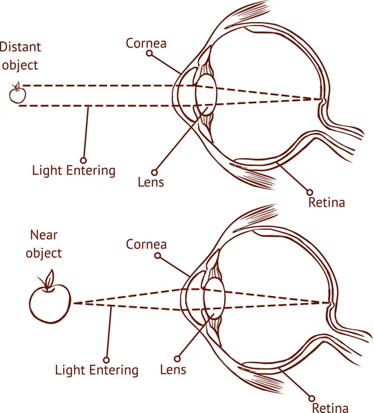 Miopía y visión normal (ilustración de vectores de color)  ) — Archivo Imágenes Vectoriales