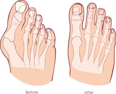 Human foot deformity. Hallux valgus and tailors bunion. clipart