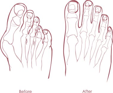 İnsan ayak deformitesi. Hallux valgus ve terziler şişik.