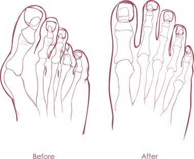 Human foot deformity. Hallux valgus and tailors bunion. clipart