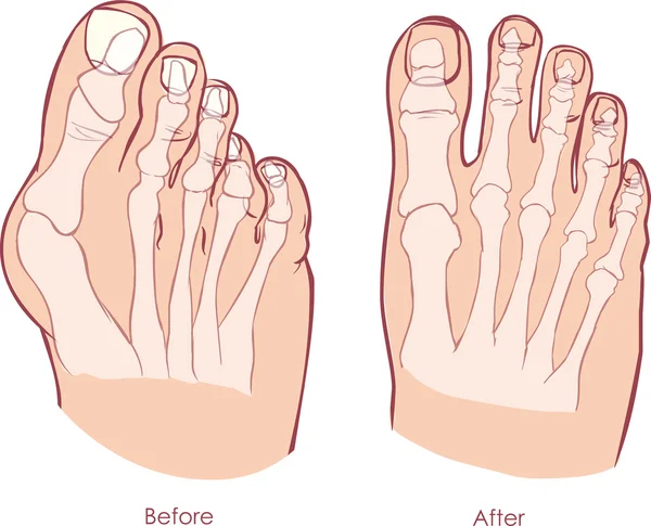 Deformidade do pé humano. Hallux valgus e alfaiates joanete . —  Vetores de Stock