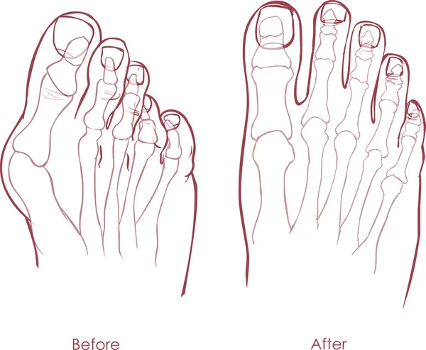 Cacat kaki manusia. Hallux valgus dan tailors bunion . - Stok Vektor