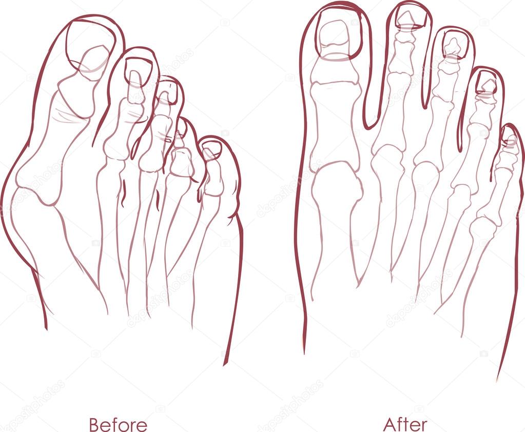 Human foot deformity. Hallux valgus and tailors bunion. Stock Vector by ...