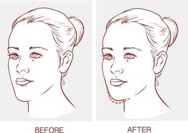 vektör çizim Underbite Çene Cerrahisi