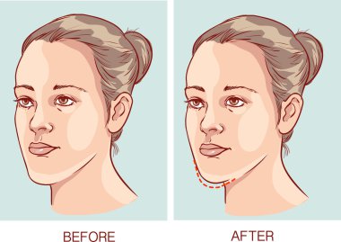 vektör çizim Underbite Çene Cerrahisi