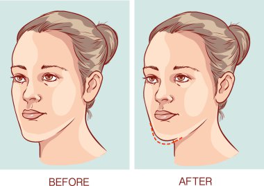 vector illustration of a Underbite Jaw surgery clipart