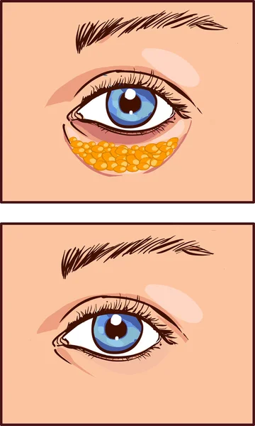 Ilustración vectorial de una blefaroplastia estética ocular — Vector de stock