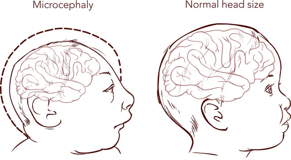 ภาพของทารกแรกเกิดที่มีโรค Microcephaly ที่เกิดจาก — ภาพเวกเตอร์สต็อก