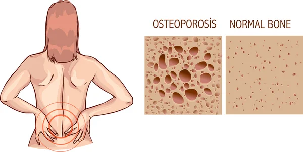 Osteoporosi, anatomia ossea umana. Illustrazione medica sano b — Vettoriale Stock