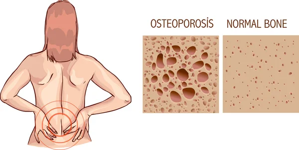 Osteoporose, anatomia óssea humana. Ilustração médica saudável b — Vetor de Stock