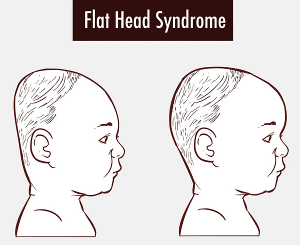 Flat Head Syndrome Brain Vector Illustration — Stock Vector