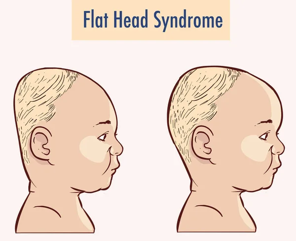 Flat Head Syndrome Brain Vector Illustration — Stock Vector