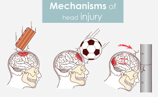Mechanisms Head Injury Vector Illustration — Stock Vector