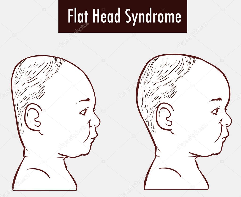 Flat Head Syndrome  Brain  vector illustration