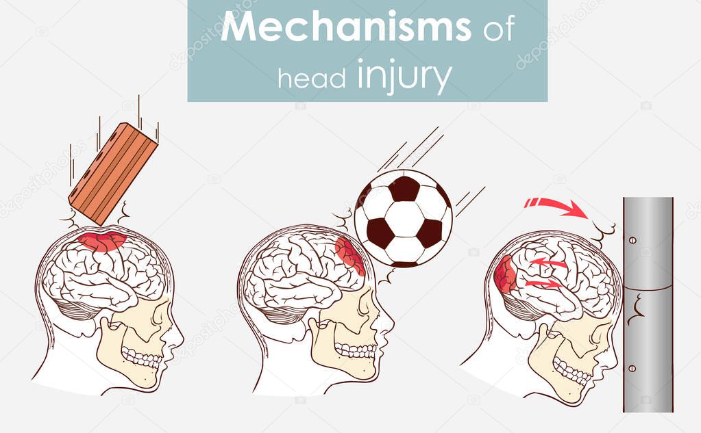 Mechanisms of head injury vector illustration
