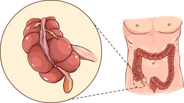 with detail of an appendicitis clipart
