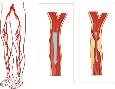 Vascular System Legs. Atherosclerosis in artery clipart
