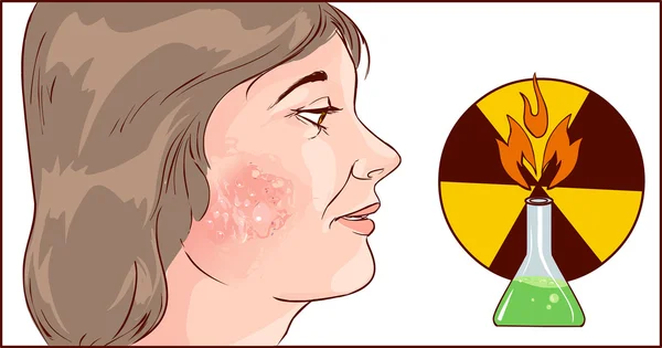 Chemical burns to face — Stock Vector