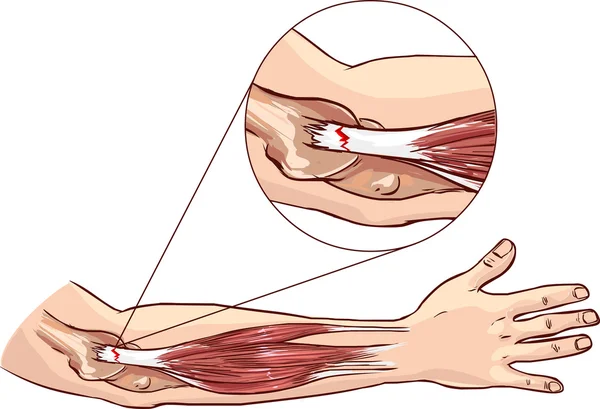 Codo de tenista - desgarro en el tendón extensor común del brazo — Archivo Imágenes Vectoriales