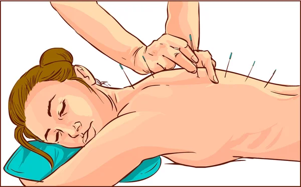 Ilustração vetorial de uma mulher em tratamento de acupuntura —  Vetores de Stock