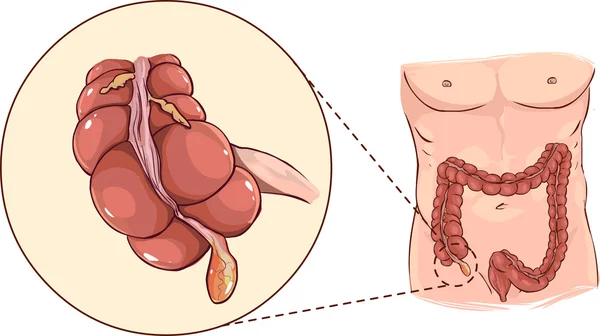 Con detalle de una apendicitis — Archivo Imágenes Vectoriales