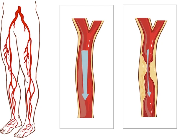 Piernas del sistema vascular. Aterosclerosis en la arteria — Archivo Imágenes Vectoriales