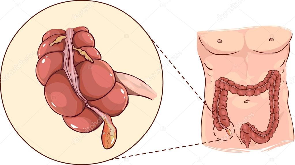 with detail of an appendicitis