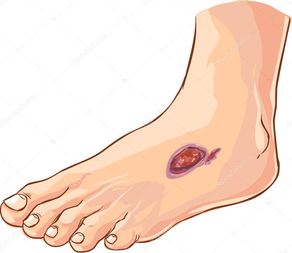 vector illustration of a Diabetic foot