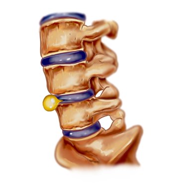 vector illustration of a slipped disc