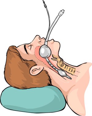Technique of tubal intubation clipart