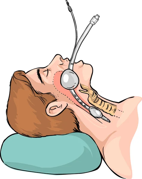 Technique of tubal intubation — Stock Vector