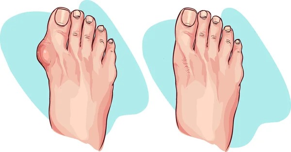 Bunion vóór en na de operatie. — Stockvector