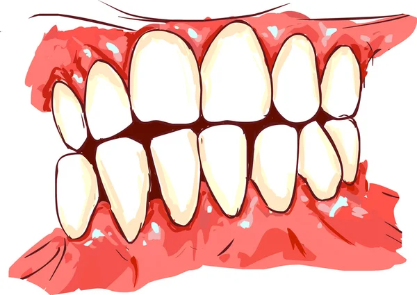Vector illustration of a gum disease — Stock Vector