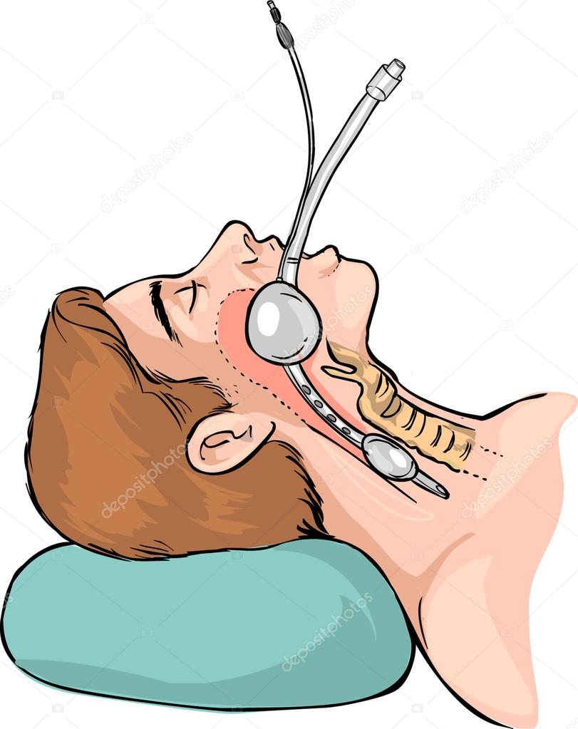 Vector illustration of a Technique of tubal intubation