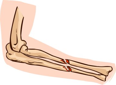 medical illustration of arm bone clipart