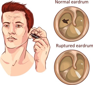 vector illustration of a tympanic membrane clipart