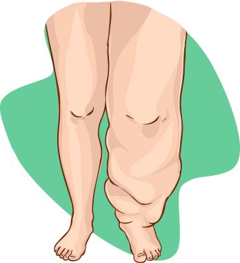 Lymphedema of the disease clipart