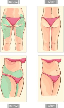 vektör çizim bir liposuction