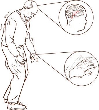 Old man with Parkinson symptoms difficult walking clipart
