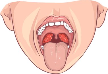 vector illustration of a Tonsillitis bacterial clipart