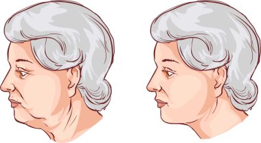 vector illustration of a face lift before and after treatment clipart