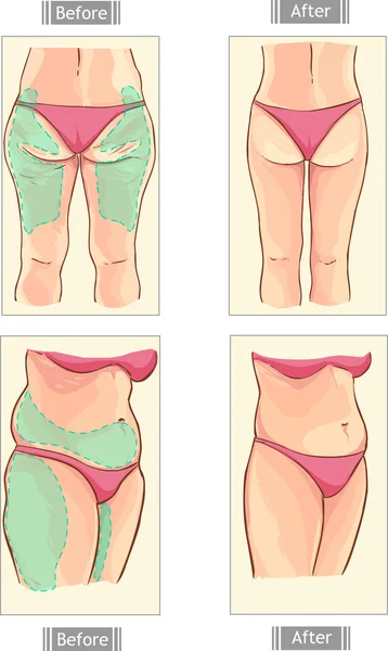 Ilustração vetorial de uma lipoaspiração — Vetor de Stock